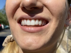 veneers, woman with veneers smiling