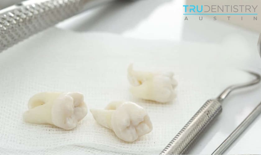 Wisdom Tooth Extraction - TRU Dentistry Austin - Dentist Austin TX