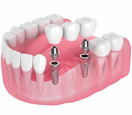 Implant Dentist Austin