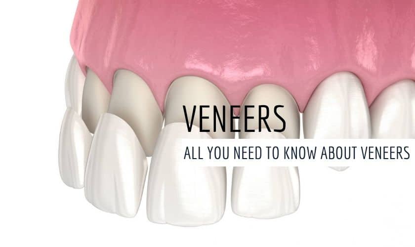 Dental Veneers in Austin