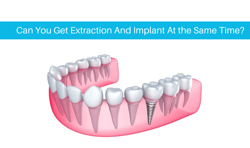 Teeth Extraction And Implants
