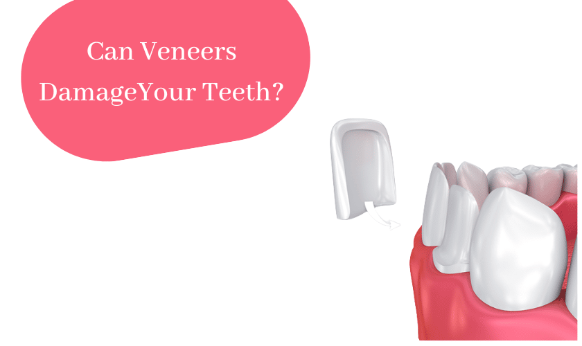 Can Veneers damage Your Teeth?