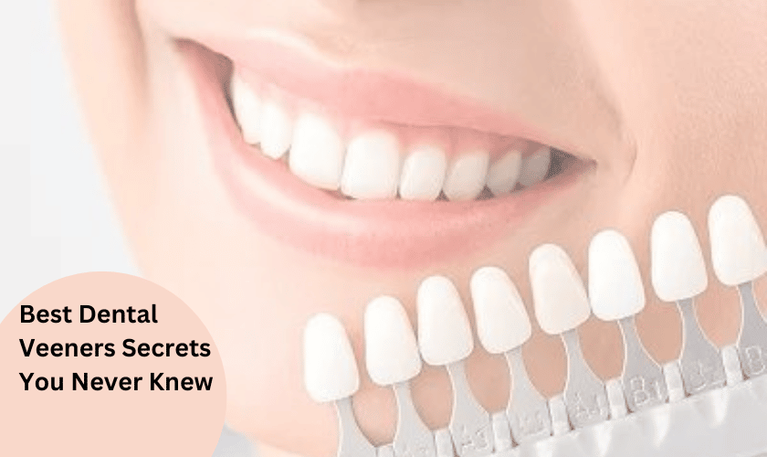 Best Dental Veeners Secrets You Never Knew