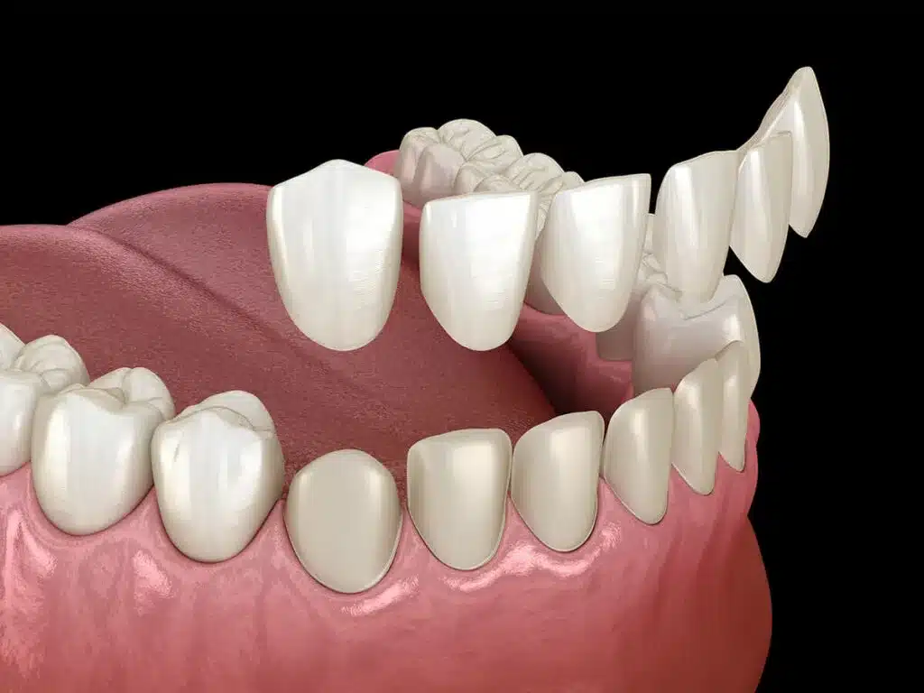 Dental Veneers - Graphics image of Dental Veneers
