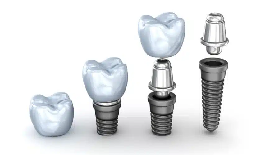 Dental implant-different types of dental implant