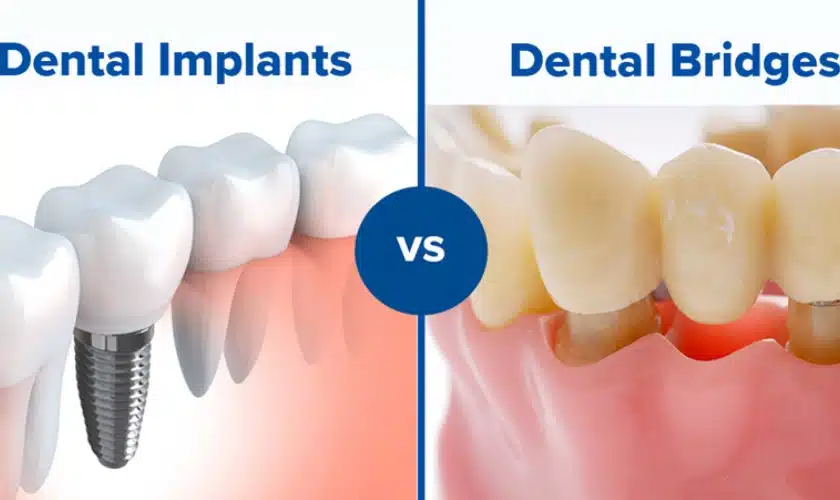 Image of dental-implants-VS-dental-Bridges