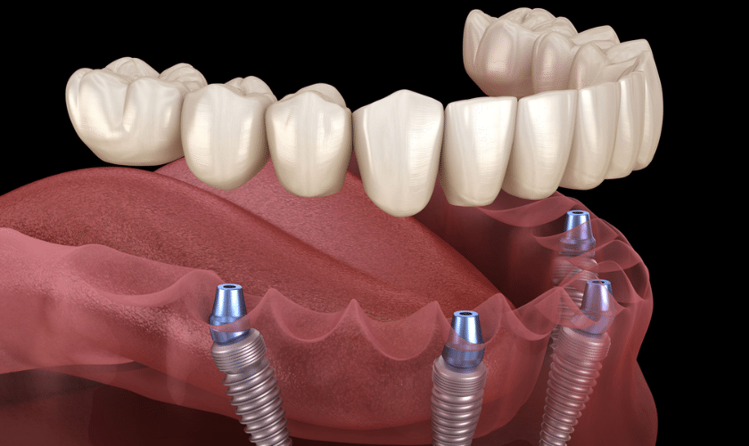 Are Full-mouth Dental Implants Worth It