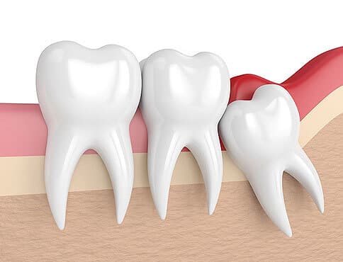 Image Of Tooth Extractions In Austin
