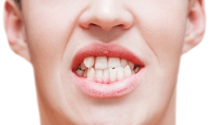 Can A Cosmetic Dentist Fix A Crooked Teeth