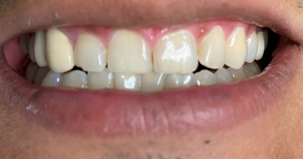 After Smile Transformations By Dentist Austin