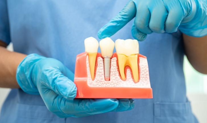 pain management after a root canal