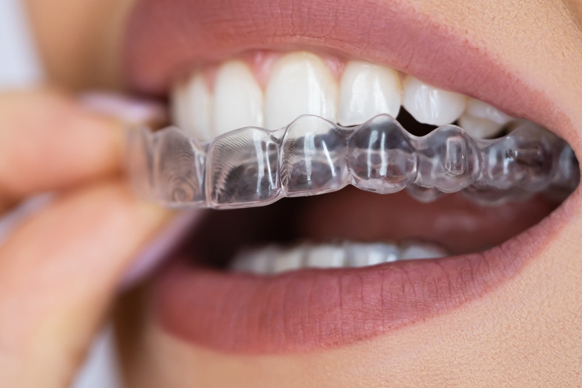 Clear Aligners