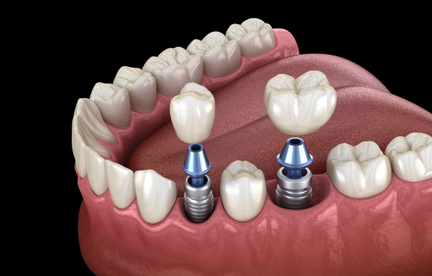 dental-implant